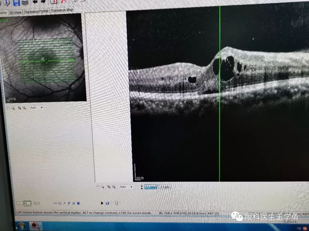 视网膜劈裂还是水肿