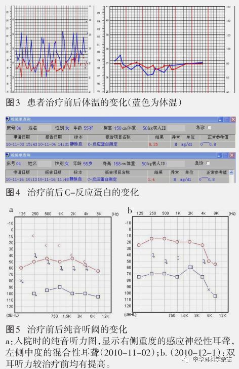 双耳听力下降伴左耳疼痛2月,间断发热1月,头痛1周,左侧口角歪斜2天