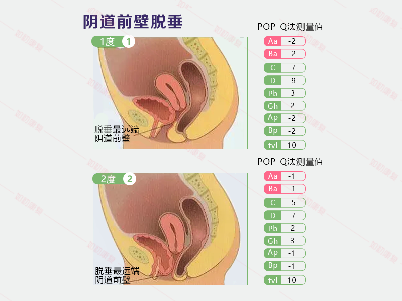 阴道膨出,子宫下垂了几厘米?属于什么程度?几张图片告诉你!