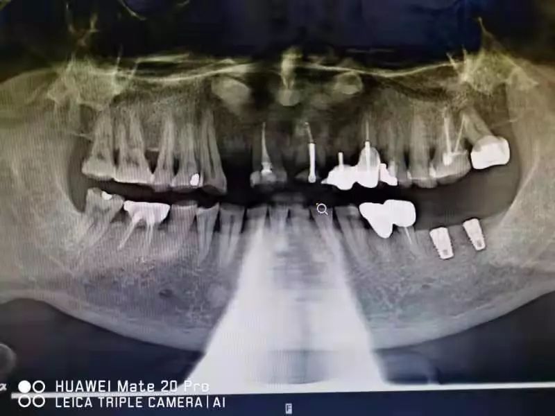 最美医瞬间再次展现完美的种植牙手术