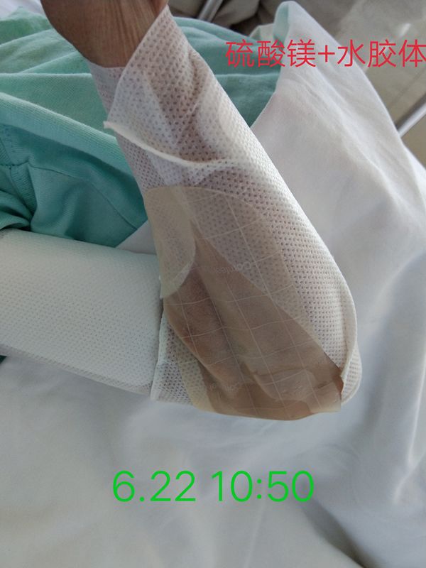 发现患者出现上述情况后,立即给予硫酸镁湿敷,穿刺处涂喜辽妥乳膏,水