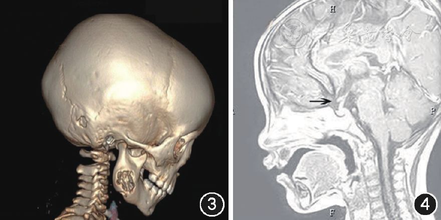 图3朗格罕组织细胞增生症患儿头颅ct三维重建示右侧下颌骨及颞骨近