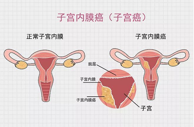 妇科肿瘤发作前,给你了n次识别机会,每个女性都该记住