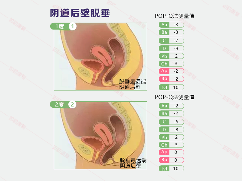 阴道后壁膨出(直肠脱垂,严重的直肠脱垂可导致肠道蠕动障碍,导致排便