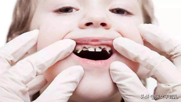 一歲寶寶牙齒爛，可能就是因為父母的這3個壞習慣