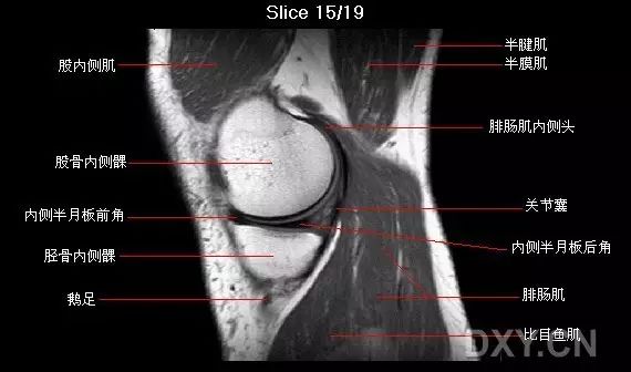 解剖膝关节系统解剖图矢状mri示意图