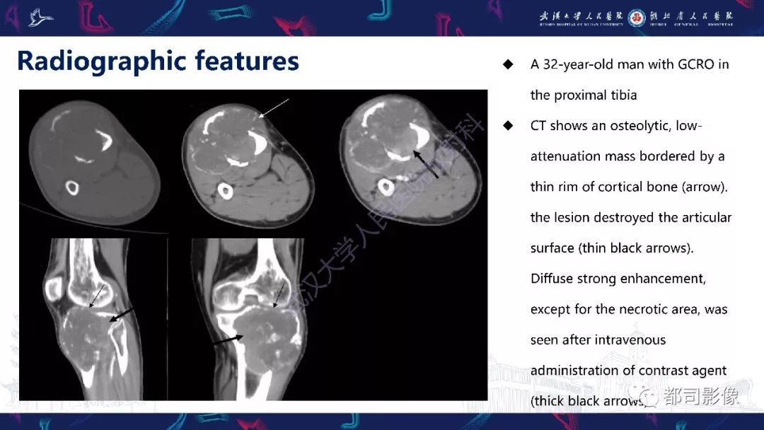 富于巨细胞性骨肉瘤影像诊断