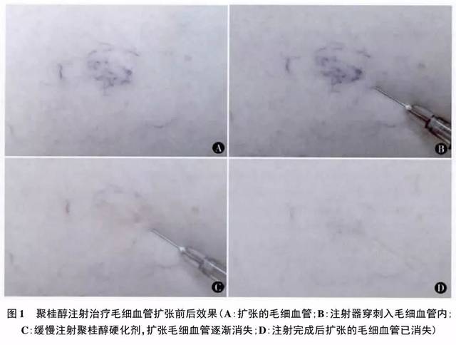 文献速递 | 1%聚桂醇硬化剂治疗下肢毛细血管扩张