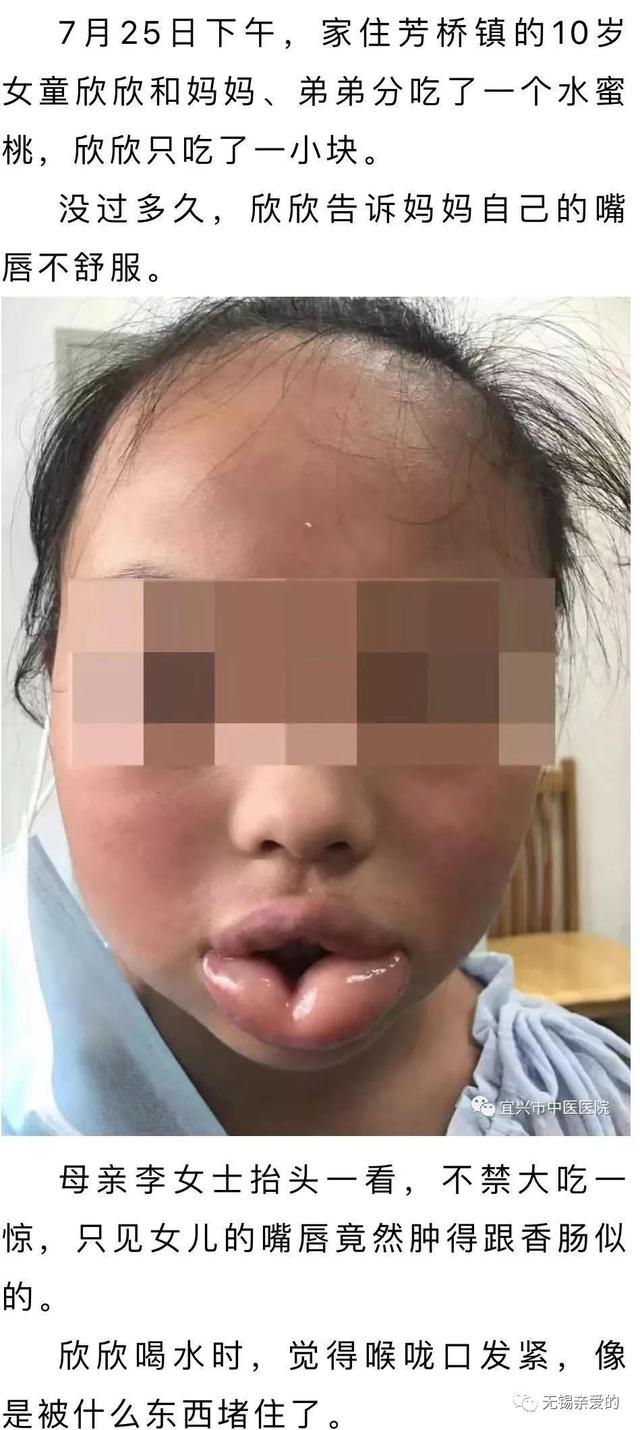 差点窒息无锡10岁女童咬了一口水蜜桃嘴唇肿得像香肠