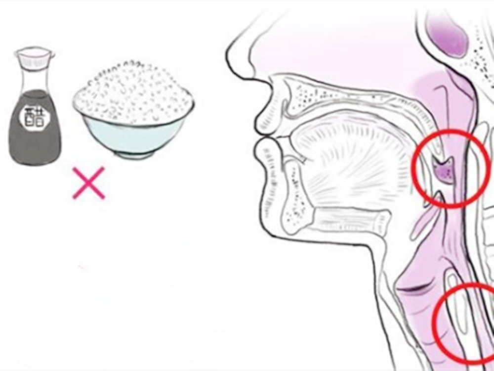                     原创            宝宝吃鱼被鱼刺卡喉咙，妈妈的取刺方式，让儿科医生称赞不已