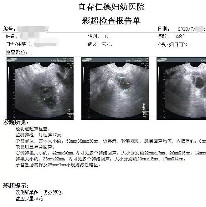 注:术后b超显示卵巢多个优势卵泡