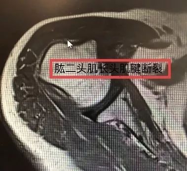 术前mri:如上图,冈上肌腱完全断裂,肩胛下肌大部分撕裂,肱二头肌长头