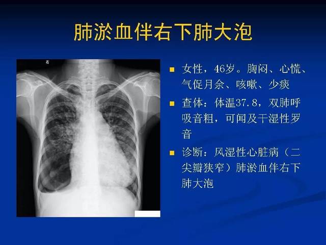 不同类型肺水肿的影像表现影像天地