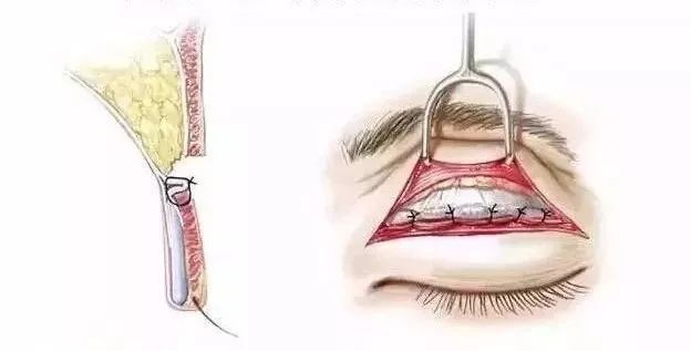 埋线双眼皮原理是什么_埋线双眼皮图片