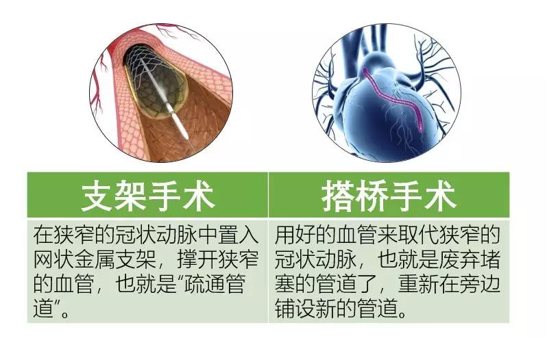 心脏支架,心脏搭桥哪个更耐用?4个手术你必知的"潜规则"