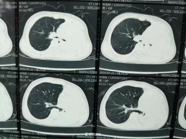 4岁男童咳嗽致左肺“消失”孩子出现这些症状家长要注意了