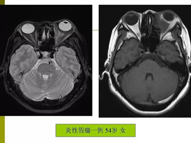 部分眼眶疾病的mri表现影像天地