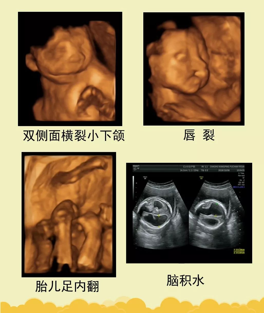 备注:胎儿畸形或异常是动态发展的,具有许多不可预知性,四维彩超检查