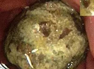                     8岁女童肾癌离世，医生道出病因，爸爸崩溃大哭：都怪我！