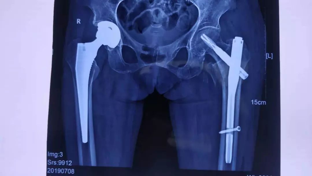 老年患者,右侧股骨颈骨折全髋关节置换术后2年,左侧股骨转子间再次