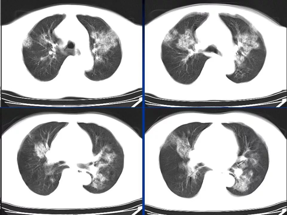 不同类型肺水肿的影像表现 | 影像天地