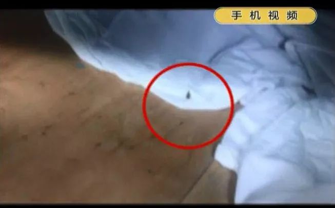 广东男孩在医院输液时总感觉被虫子咬,一掀被子好多蟑螂爬来爬去!