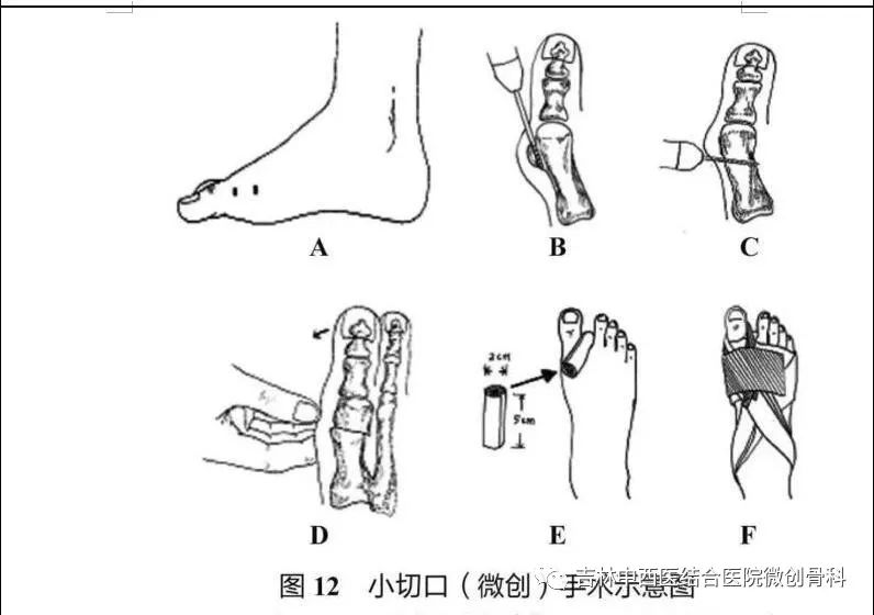 微创技术治疗拇外翻让美丽从足部开始