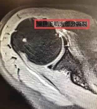 【筋骨堂】一种常被误诊为"肩周炎"的肩部疼痛——肩袖损伤