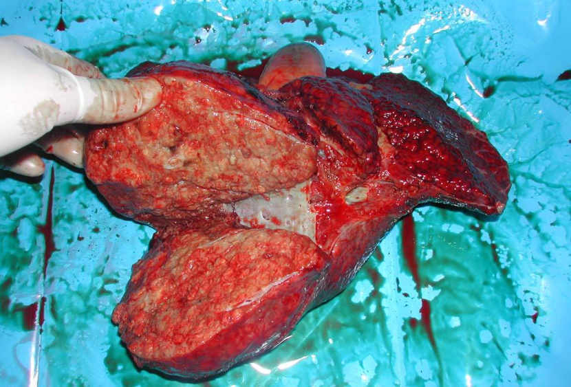 肝区越痛就表示肝癌越严重吗?肝癌晚期还能活多久?