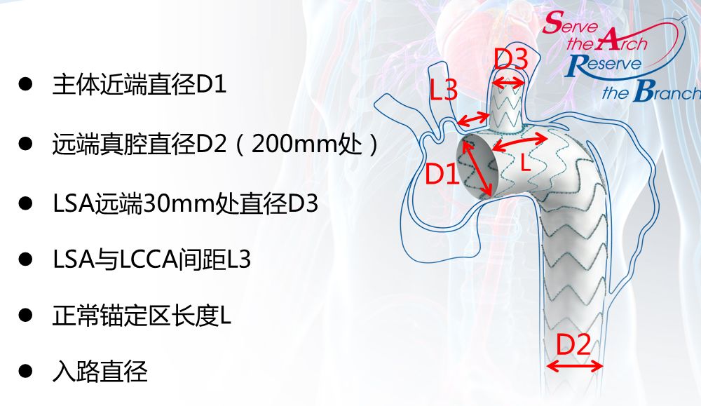 病例分享成都医学院第一附属医院血管外科应用castor03分支型支架