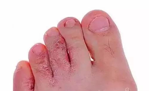 足癣是一种很常见的真菌感染性皮肤病,俗称脚气.
