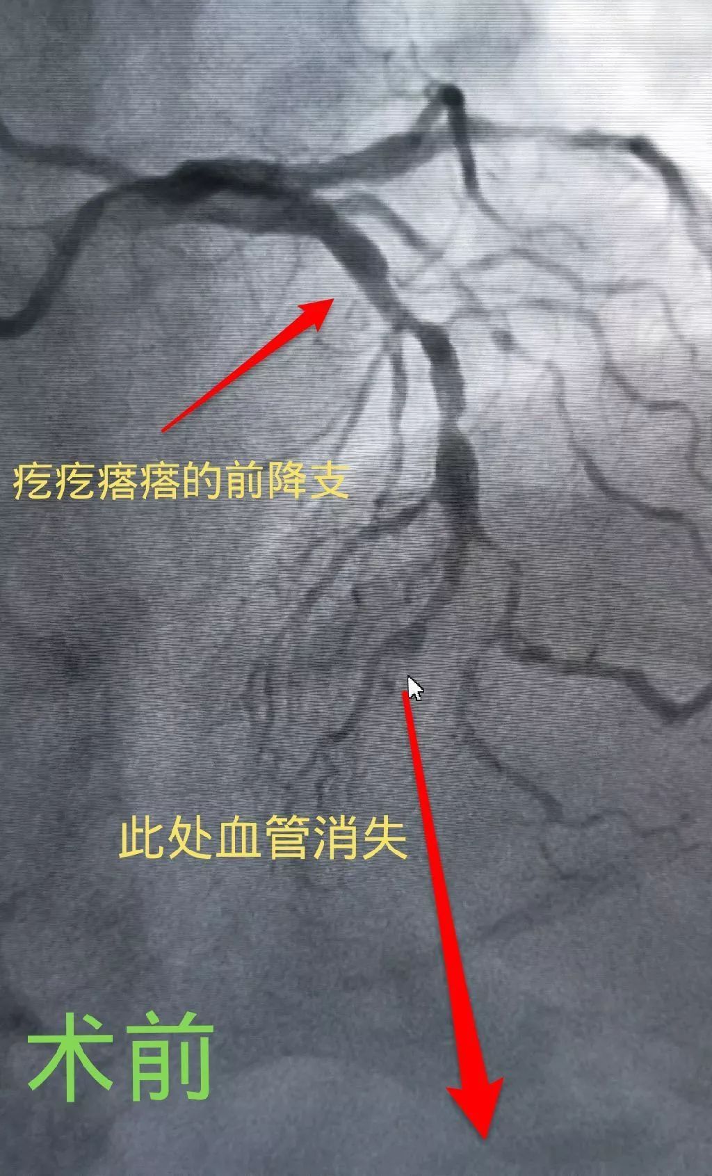 不仅仅是闭塞,整个前降支就像一串香肠,疙疙瘩瘩,好几处严重狭窄