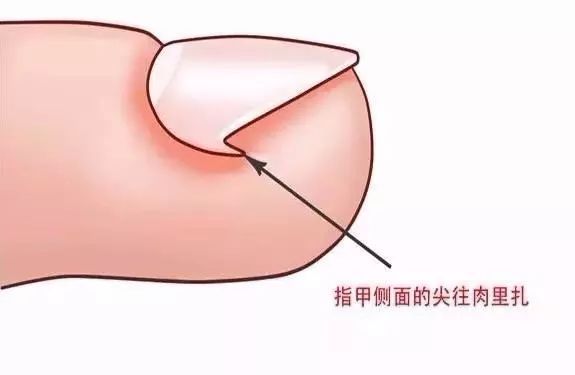 科普走路运动趾甲疼一不留意还发炎市一医院有治疗嵌甲新方法