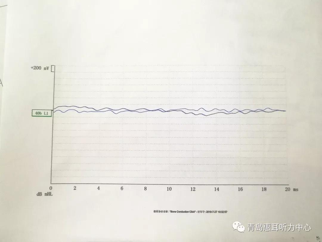 双耳极重度听损婴幼儿的干预方案