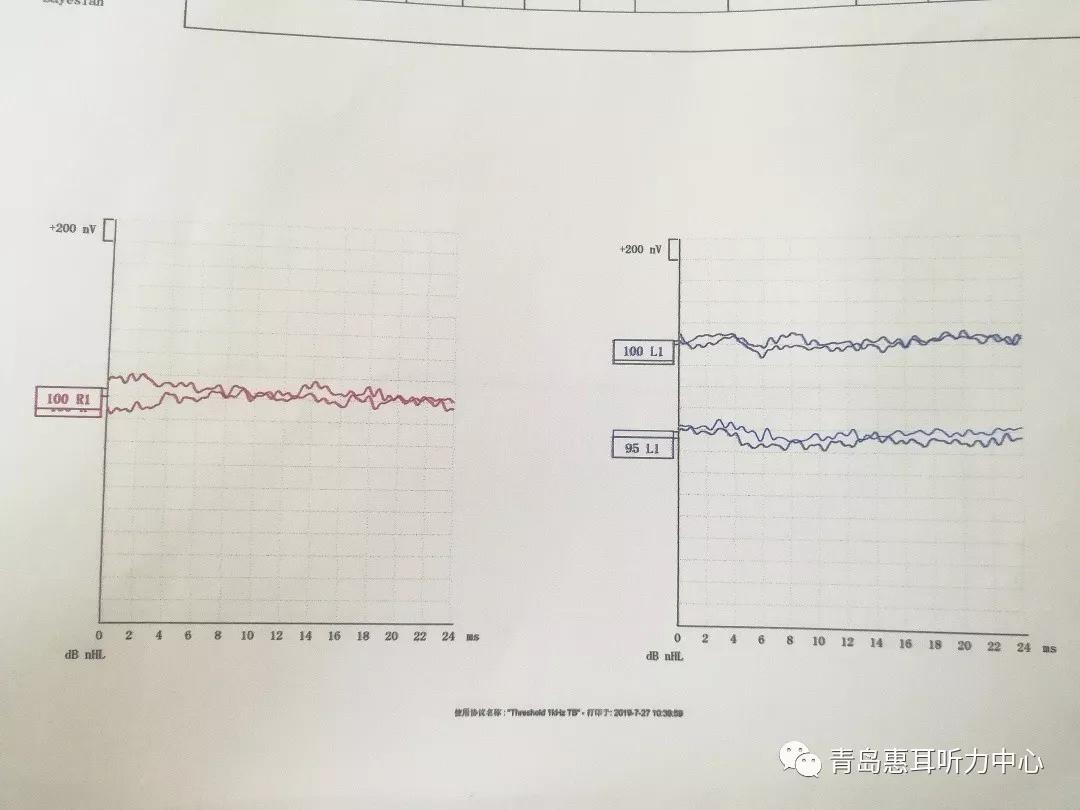 abr 左100dbnhl 右>100dbnhl裸耳检查内容声导抗左耳as型右耳a型