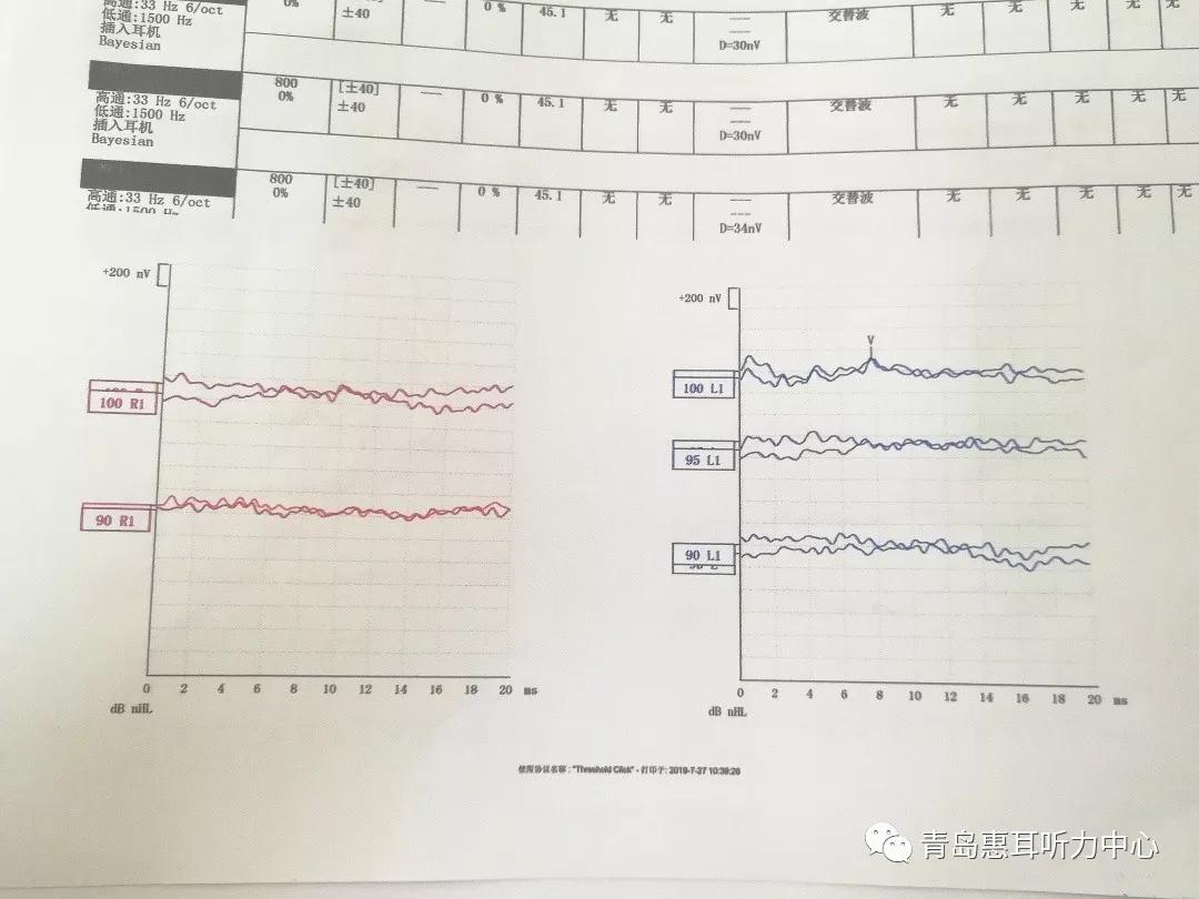 裸耳检查内容声导抗左耳as型右耳a型 dpoae双耳未通过各项裸耳听力