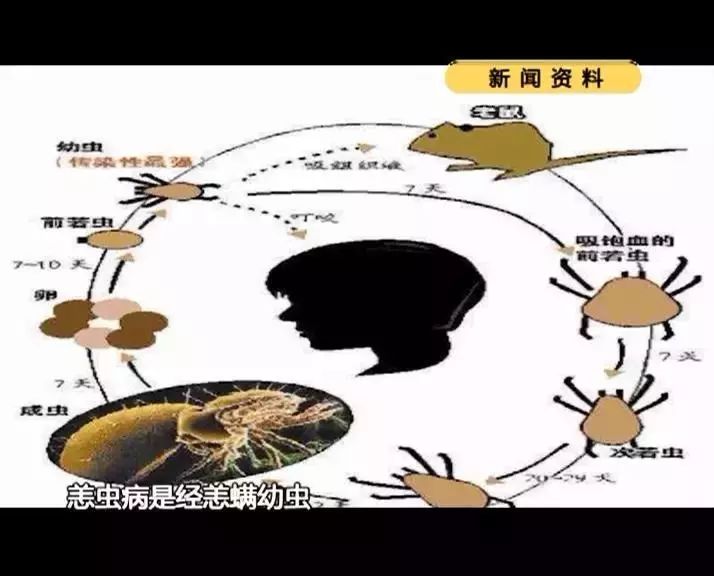 恙虫病 首发症状是高热