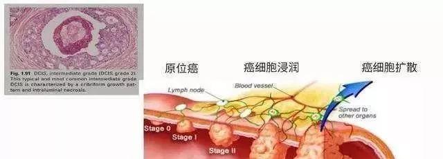 微浸润癌微浸润指的是癌细胞已突破了基底膜并且开始周围