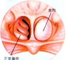 如果确诊是鼻息肉,应在医生