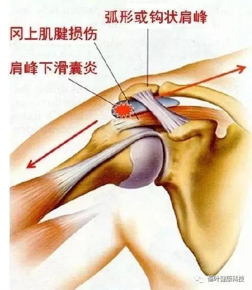 慢性损伤之肩峰下滑囊炎