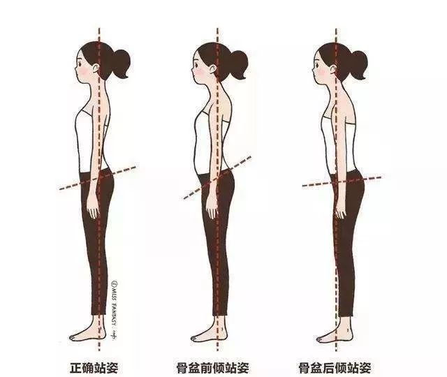 骨盆前倾是指骨盆向前病态的偏移,造成腰椎不正常的生理前凸.