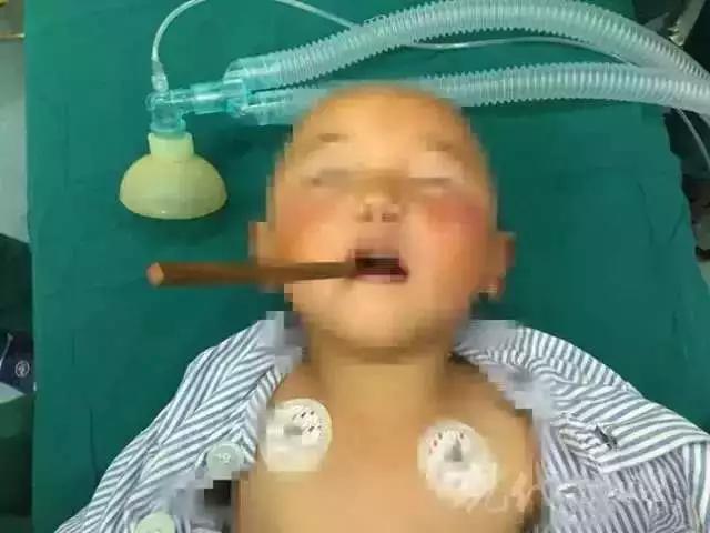                     20cm的筷子差点要了2岁宝宝的命！这些潜在 “杀手”一定要小心...