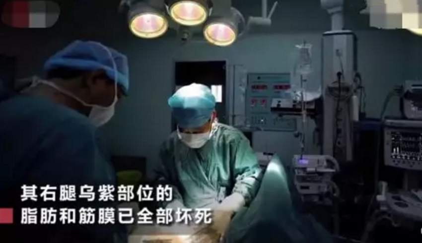                     女童挠破蚊子包，大腿筋膜坏死经历三次手术，这种致命病菌要小心