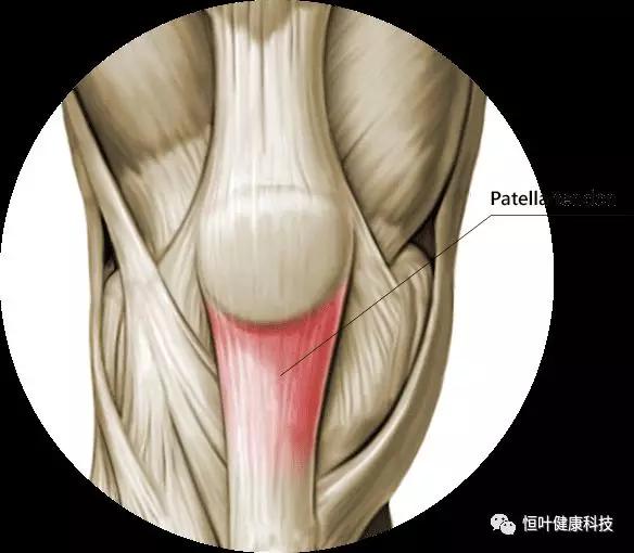 膝前痛的元凶——髌腱病_肌腱