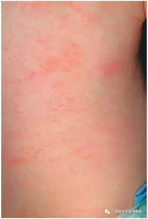 上图是孩子发热3天后出现的皮疹,表现为红色斑丘疹,图片来自hurwitz