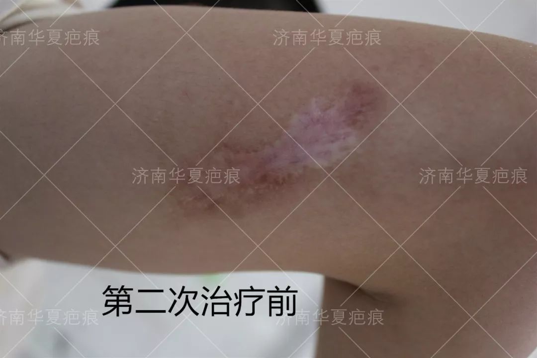 新闻速递有疤小伙儿通过了军检