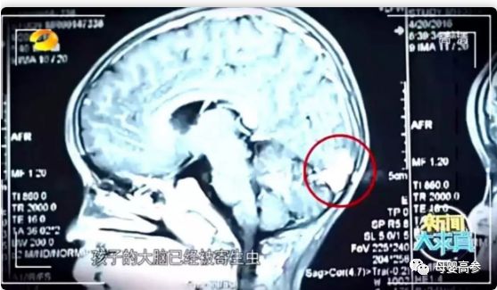                     5个月大女婴双肾竟长满结石！说了多少次，这些东西不能喂！
