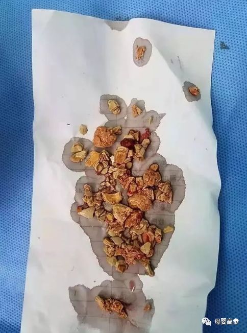                     5个月大女婴双肾竟长满结石！说了多少次，这些东西不能喂！