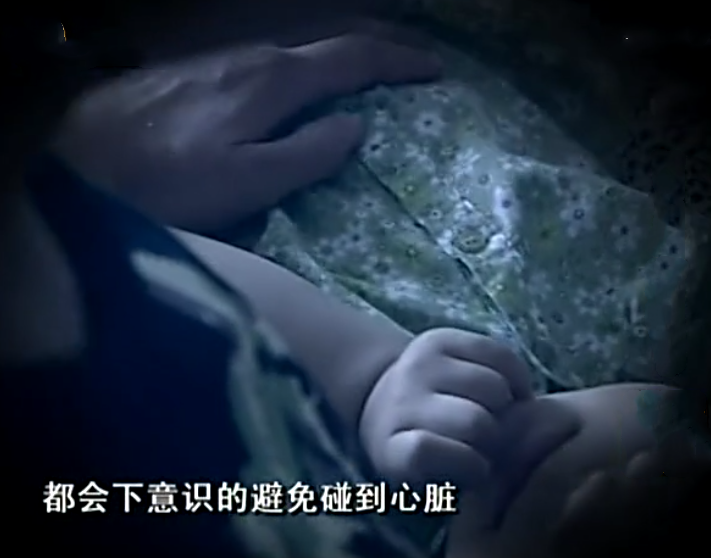                     男子心脏外露24年，肉眼可见血管和动脉，为遮挡夏天穿两件衣服