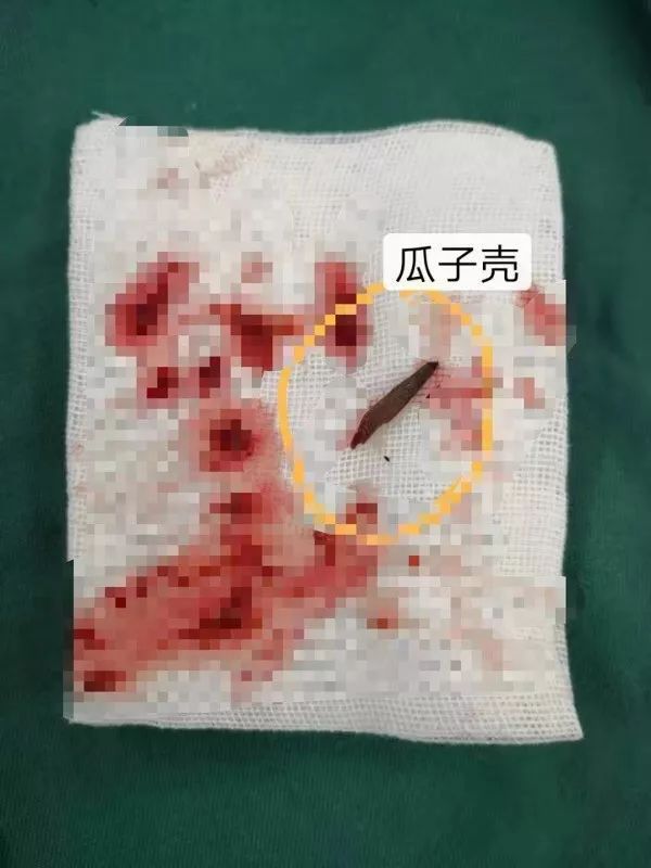                     头一次见！瓜子壳刺破宝宝直肠，竟一路“漂移”到了屁股上